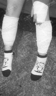 脚淤青图片,揭秘淤青形成与恢复过程